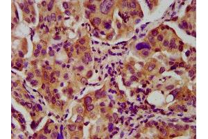 IHC image of ABIN7161101 diluted at 1:600 and staining in paraffin-embedded human lung cancer performed on a Leica BondTM system. (Nebulin 抗体  (AA 245-373))