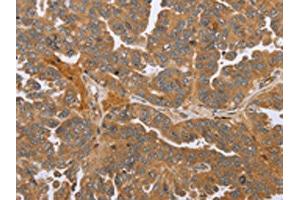 The image on the left is immunohistochemistry of paraffin-embedded Human ovarian cancer tissue using ABIN7191664(NMT1 Antibody) at dilution 1/45, on the right is treated with synthetic peptide. (NMT1 抗体)