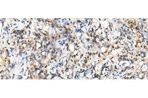 Immunohistochemistry of paraffin-embedded Human lung cancer tissue using NUDT18 Polyclonal Antibody at dilution of 1:40(x200)