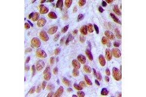 Immunohistochemical analysis of CBP80 staining in human breast cancer formalin fixed paraffin embedded tissue section.