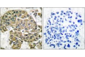 Immunohistochemistry analysis of paraffin-embedded human breast carcinoma tissue, using Mammaglobin B Antibody. (SCGB2A1 抗体  (AA 10-59))