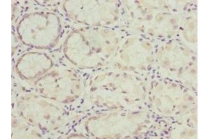 Immunohistochemistry of paraffin-embedded human gastric cancer using ABIN7161726 at dilution of 1:100 (NLE1 抗体  (AA 206-485))