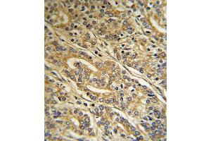 Formalin-fixed and paraffin-embedded human Prostate carcinoma reacted with ACOT8 Antibody (C-term), which was peroxidase-conjugated to the secondary antibody, followed by DAB staining. (ACOT8 抗体  (C-Term))