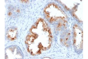 Formalin-fixed, paraffin-embedded human Prostate Carcinoma stained with AMACR / p504S Mouse Monoclonal Antibody (AMACR/1864). (AMACR 抗体  (AA 297-394))