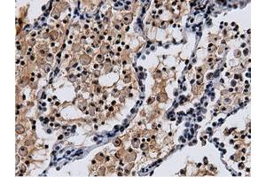 Immunohistochemical staining of paraffin-embedded Adenocarcinoma of Human breast tissue using anti-NT5DC1 mouse monoclonal antibody. (NT5DC1 抗体)
