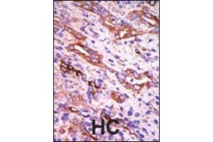 Formalin-fixed and paraffin-embedded human cancer tissue reacted with the primary antibody, which was peroxidase-conjugated to the secondary antibody, followed by DAB staining. (GRK1 抗体  (C-Term))