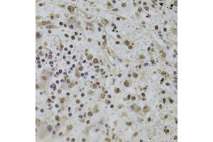 Immunohistochemistry of paraffin-embedded human liver cancer using INTS6 Antibody (ABIN2563455) at dilution of 1:100 (40x lens). (INTS6 抗体)