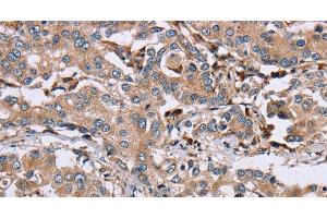Immunohistochemistry of paraffin-embedded Human liver cancer using MAGEA3 Polyclonal Antibody at dilution of 1:50 (MAGEA3 抗体)