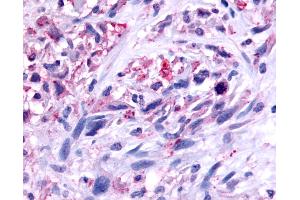 Anti-GPR45 antibody IHC of human Brain, Glioblastoma. (GPR45 抗体  (C-Term))