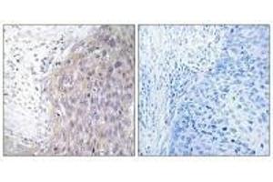 Immunohistochemistry analysis of paraffin-embedded human cervix carcinoma tissue using POLG2 antibody. (POLG2 抗体)
