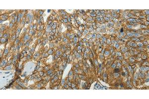 Immunohistochemistry of paraffin-embedded Human ovarian cancer tissue using SLC16A1 Polyclonal Antibody at dilution 1:50