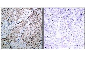Immunohistochemical analysis of paraffin-embedded human breast carcinoma tissue using p53 (phospho- Ser315) antibody (E011100). (p53 抗体  (pSer315))