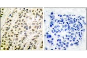 Immunohistochemistry analysis of paraffin-embedded human breast carcinoma tissue, using DP-1 Antibody. (TGM4 抗体  (AA 361-410))