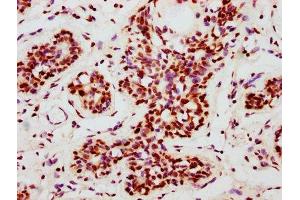 IHC image of ABIN7127694 diluted at 1:100 and staining in paraffin-embedded human breast cancer performed on a Leica BondTM system. (Recombinant NRF2 抗体  (pSer40))