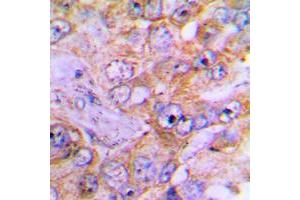 Immunohistochemical analysis of Caspase 3 staining in human lung cancer formalin fixed paraffin embedded tissue section. (Caspase 3 抗体  (Center))