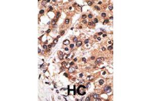 Formalin-fixed and paraffin-embedded human hepatocellular carcinoma tissue reacted with MLLT3 polyclonal antibody  , which was peroxidase-conjugated to the secondary antibody, followed by AEC staining. (AF9 抗体  (C-Term))