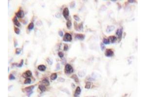 Immunohistochemistry analyzes of hnRNP C1/2 antibody in paraffin-embedded human breast carcinoma tissue. (HNRNPC 抗体)