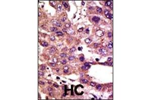 Formalin-fixed and paraffin-embedded human cancer tissue reacted with the primary antibody, which was peroxidase-conjugated to the secondary antibody, followed by DAB staining. (AMFR 抗体  (AA 571-601))