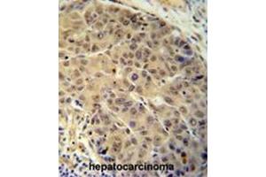 BUD13 antibody (C-term) immunohistochemistry analysis in formalin fixed and paraffin embedded human hepatocarcinoma followed by peroxidase conjugation of the secondary antibody and DAB staining. (BUD13 抗体  (C-Term))