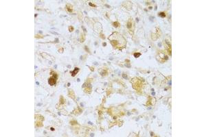 Immunohistochemistry of paraffin-embedded human brain astrocytoma using FCN1 Antibody. (FCN1 抗体  (AA 30-326))