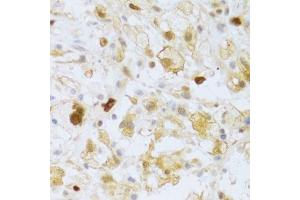 Immunohistochemistry of paraffin-embedded human brain astrocytoma using FCN1 Antibody. (FCN1 抗体  (AA 30-326))