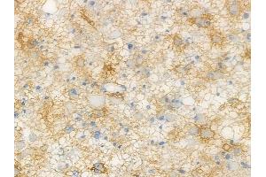 ABIN6264730 and ABIN6272560 at 1/100 staining human astrocytoma by IHC-P. (RHCG 抗体  (C-Term))