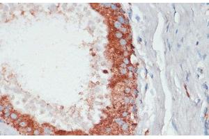 Immunohistochemistry of paraffin-embedded Human mammary cancer using PGK2 Polyclonal Antibody at dilution of 1:100 (40x lens). (PGK2 抗体)