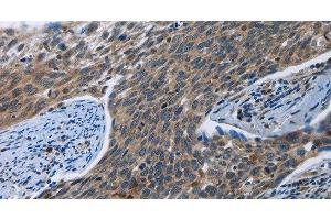 Immunohistochemistry of paraffin-embedded Human cervical cancer tissue using SYT3 Polyclonal Antibody at dilution 1:40 (Synaptotagmin 3 抗体)