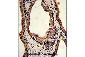 Formalin-fixed and paraffin-embedded human prostate carcinoma reacted with TPI1 Antibody (C-term), which was peroxidase-conjugated to the secondary antibody, followed by DAB staining. (TPI1 抗体  (C-Term))