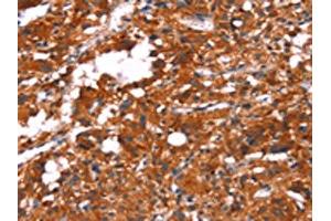 The image on the left is immunohistochemistry of paraffin-embedded Human thyroid cancer tissue using ABIN7190641(FEM1A Antibody) at dilution 1/20, on the right is treated with synthetic peptide. (FEM1A 抗体)