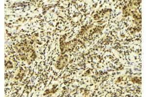 ABIN6278125 at 1/100 staining Human breast cancer tissue by IHC-P. (UNG 抗体  (Internal Region))