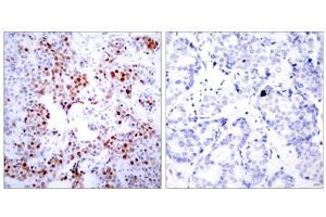 Immunohistochemical analysis of paraffin- embedded human breast carcinoma tissue using ATF-2 (Ab-69 or 51) antibody(E021030). (ATF2 抗体)