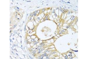 Immunohistochemistry of paraffin-embedded Human colon carcinoma using GNAI3 Polyclonal Antibody at dilution of 1:100 (40x lens). (GNAI3 抗体)