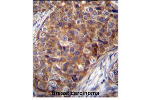 COX7A2L Antibody (Center) (ABIN656272 and ABIN2845583) immunohistochemistry analysis in formalin fixed and paraffin embedded human breast carcinoma followed by peroxidase conjugation of the secondary antibody and DAB staining. (COX7A2L 抗体  (AA 37-65))
