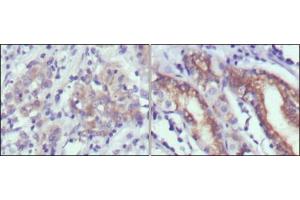 Immunohistochemical analysis of paraffin-embedded human gastric cancer (left) and normal gastric tissues (right) using CER1 antibody with DAB staining. (CER1 抗体)