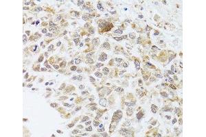 Immunohistochemistry of paraffin-embedded Human lung cancer using RNASEL Polyclonal Antibody at dilution of 1:100 (40x lens). (RNASEL 抗体)