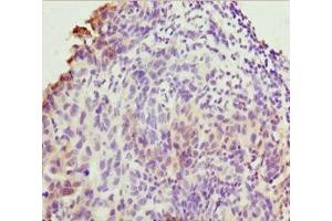 Immunohistochemistry of paraffin-embedded human bladder cancer using ABIN7173219 at dilution of 1:100 (TMEM43 抗体  (AA 80-310))