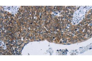 Immunohistochemistry of paraffin-embedded Human cervical cancer tissue using KPNB1 Polyclonal Antibody at dilution 1:40 (KPNB1 抗体)