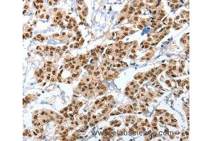 Immunohistochemistry of Human liver cancer using ANXA10 Polyclonal Antibody at dilution of 1:35 (Annexin a10 抗体)