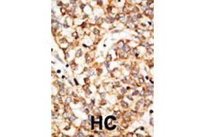 Formalin-fixed and paraffin-embedded human hepatocellular carcinoma tissue reacted with the APOBEC1 polyclonal antibody  , which was peroxidase-conjugated to the secondary antibody, followed by DAB staining. (APOBEC1 抗体  (N-Term))