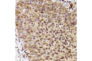 Immunohistochemistry of paraffin-embedded human lung cancer using ERK1 Rabbit mAb  at dilution of 1:100 (40x lens).