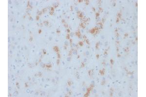 Formalin-fixed, paraffin-embedded human Hepatic Carcinoma stained with Cytochrome p450 Mouse Monoclonal Antibody (M12P4H2). (CYP2E1 抗体  (C-Term))