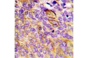 Immunohistochemical analysis of CCBL1 staining in human breast cancer formalin fixed paraffin embedded tissue section. (CCBL1 抗体)