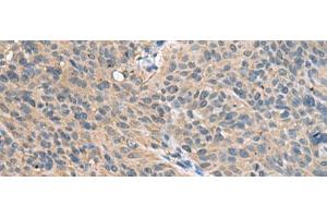 Immunohistochemistry of paraffin-embedded Human cervical cancer tissue using FAM19A4 Polyclonal Antibody at dilution of 1:55(x200) (FAM19A4 抗体)