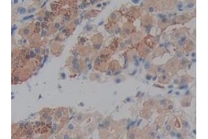 IHC-P analysis of Human Stomach cancer Tissue, with DAB staining. (Prekallikrein 抗体  (AA 156-364))