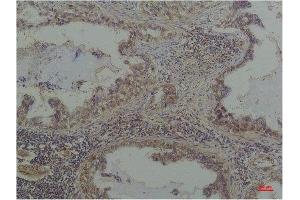 Immunohistochemistry (IHC) analysis of paraffin-embedded Human Lung Caricnoma using Phosphoserine Mouse mAb diluted at 1:200. (Phosphoserine 抗体  (phosphorylated))