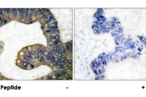 Immunohistochemical analysis of paraffin-embedded human colon carcinoma tissue using PLA2G4A polyclonal antibody . (PLA2G4A 抗体)