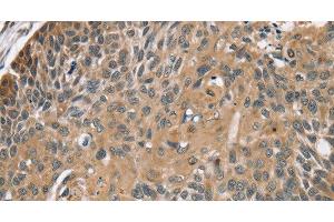 Immunohistochemistry of paraffin-embedded Human esophagus cancer using TRIM3 Polyclonal Antibody at dilution of 1:45 (TRIM3 抗体)