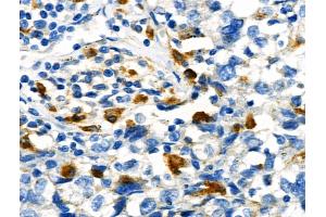 Phospho-STUB1/CHIP (Ser19) Antibody at 1/100 staining Human breast cancer by IHC-P. (STUB1 抗体  (pSer19))