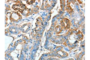 The image on the left is immunohistochemistry of paraffin-embedded Human thyroid cancer tissue using ABIN7128299(AGR3 Antibody) at dilution 1/15, on the right is treated with fusion protein.